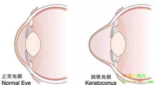 1571986328231991.jpg 圆锥角膜.jpg