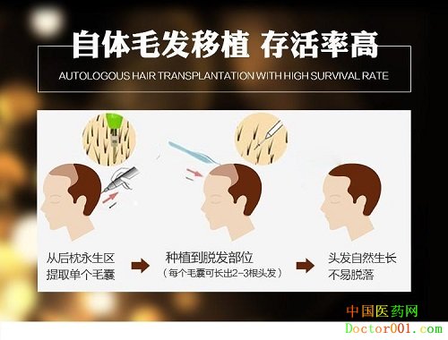 1577673727948968.jpg 自体毛发移植.jpg