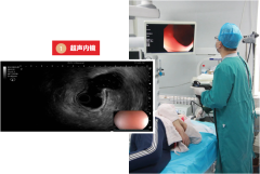 丁义山专科医院超声内镜检查技术，胃肠疾病诊断透视眼